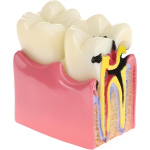 Modelo Educativo de Caries Dentales, Ampliado 6 Veces en Sección Transversal, Material de Resina para Educación Anatómica y Enseñanza de Salud Dental - Product Image 1