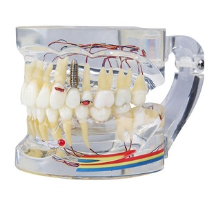 แบบจำลองฟันโปร่งใสสำหรับโรคต่างๆ แบบจำลองฟันปลอมใสสำหรับการฝึกหัดทางทันตกรรม แบบจำลองฟันมาตรฐานสำหรับการฝึกทันตแพทย์ แบบจำลองฟันที่ถอดออกได้สำหรับการศึกษาโรคทางทันตกรรม - Product Image 1