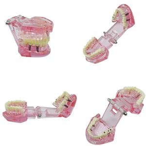 Modelo de Entrenamiento de Implantes Dentales (1 Unidad) con Dientes Removibles y Demostración de Patología para Práctica de Implantes y Restauración de Puentes - Product Image 3