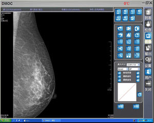 جهاز تصوير الثدي بالأشعة السينية الرقمي مقاس 8 بوصات، نظام تصوير الثدي بقدرة 6.2 كيلو واط - Product Image 5