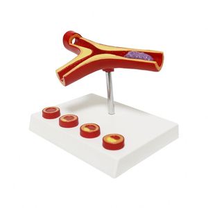 Modelo de Aterosclerosis y Trombosis Humana KyrenMed, Modelo Cardiovascular de Aterosclerosis Ampliado 10 Veces - Product Image 4