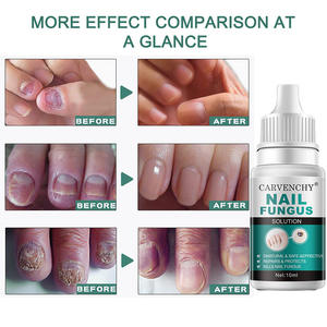 <span class=keywords><strong>Esmalte</strong></span> de <span class=keywords><strong>Uñas</strong></span> Natural y Seguro, Esencia Efectiva <span class=keywords><strong>para</strong></span> Reparar <span class=keywords><strong>Uñas</strong></span> Grises, Cuidado de la Piel, Solución Herbal contra <span class=keywords><strong>Hongos</strong></span>, 3 Años de Duración, Personalizable - Product Image 2