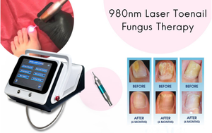 Mesin Laser Medis Kelas <span class=keywords><strong>IV</strong></span> 980nm 1470nm untuk Pengobatan Kuku Kaki, Onikoniikosis, Anti Inflamasi, dan Penghapusan Jamur Kuku Tahun <span class=keywords><strong>2026</strong></span> - Product Image 2