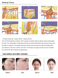 Sistema Profesional de Spa Facial 8 en 1 con Hidrodermoabrasión, Pistola de Pulverización, Terapia BIO y Ultrasonido para el Acné y la Piel Envejecida - Product Image 2