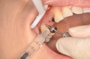 Esunix - Antiséptico Oral Específico para Periodoncia, Bacteriostático, Antibacteriano, en Tubos/Caja de <span class=keywords><strong>Gel</strong></span> Plástico, Tratamiento para Implantes Dentales - Product Image 2