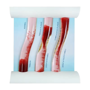 Comparaison de démonstration du flux de cohérence sanguine dans le PVC Modèle de blocage dynamique des vaisseaux de l'hyperlipidémie humaine pour la science médicale - Product Image 2