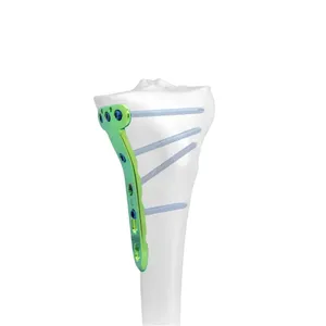 Sistem Implan Fiksasi Fraktur Tulang Pelat Pengunci Trauma Bedah Ortopedi Titanium untuk Tulang Humerus, Femur, Tibia, dan <span class=keywords><strong>Radius</strong></span> - Product Image 2