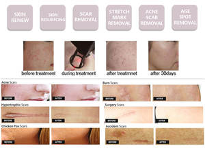 Sertifikat Medis untuk Mesin Kecantikan Laser <span class=keywords><strong>CO2</strong></span> Fraksional Penghilang Kerutan dan Pengencang Vagina 10600nm Kanada - Product Image 6