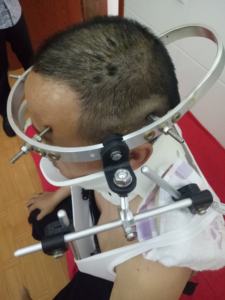 คลิปหนีบเสื้อฮาโลสำหรับการแพทย์ FM-TJ-003 อุปกรณ์ศัลยกรรมกระดูกและข้อ - Product Image 2