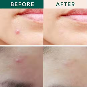 Venta caliente Pegatinas transparentes para el acné hidrocoloide mejor parche de espinillas grandes para espinillas - Product Image 6