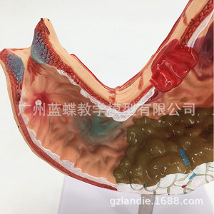 Modelo anatómico gástrico, modelo de estómago con enfermedades, modelo de demostración de enfermedades gástricas, modelo de estómago patológico, humano - Product Image 4