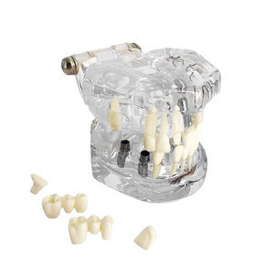 Modello di insegnamento trasparente per la carie dentale trasparente per la scienza medica - Product Image 5