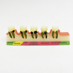 Medische Wetenschap Dummy Parodontitis Classificatie Tandheelkundig Model Voor Medische Schoolopleiding - Product Image 3