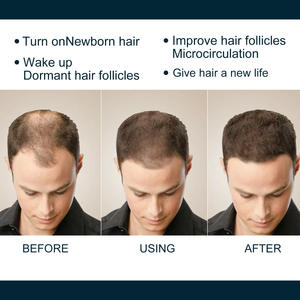 Extracto de hierbas El suero de hierbas para el crecimiento del cabello previene la pérdida de cabello Aceite para el crecimiento del cabello para hombres - Product Image 6