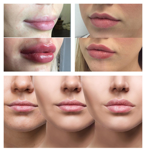 Hyaluronic Pen Acid Injectable Filler <b>Gun</b> Two in One Lip Lifting Hyaluronic Pen - Product Image 6