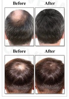 Meilleure huile de croissance des cheveux pour la calvitie Réparation du cuir chevelu Huile capillaire Anti perte de cheveux