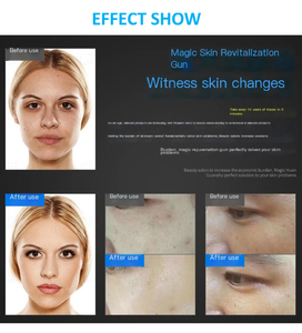 Máquina de Crioterapia Facial sin Agujas, Terapia de CO2 con Piel Congelada, Mesogun, Lifting Facial Mágico, Libre de Impuestos - Product Image 5