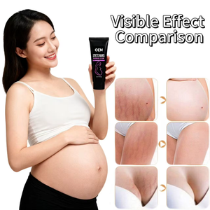 OEM自有品牌妊娠纹去除疤痕凝胶霜用于妊娠纹去除配方乳液 - Product Image 3