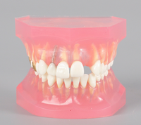 Modelo de Tratamiento de Caries con Puente de Caries e Implante