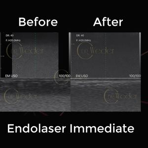 SURESULT L20 Sonda de ultrasonido de mano médica profesional Dispositivo de color lineal alimentado eléctrico para análisis de líneas finas de arrugas - Product Image 5