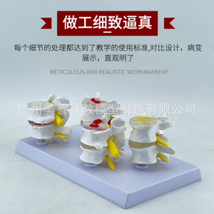 Quatre équipes de modèles pathologiques de la colonne vertébrale lombaire, quatre paires de modèles de lésions des disques lombaires, modèles de pathologie des disques intervertébraux - Product Image 4