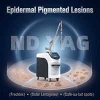 Mesin Laser Carbon Peeling Q-switched Nd Yag Profesional untuk Menghilangkan Tato 1064nm 532nm Pico Second ND:YAG Laser