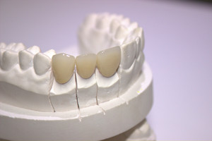 De alta calidad de CAD/CAM personalizado de circonio corona Dental - Product Image 3