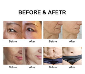 Máquina Profesional No Invasiva para Reducir Arrugas, Tensar la Piel, Reafirmar y Levantar las Líneas Finas - Product Image 6