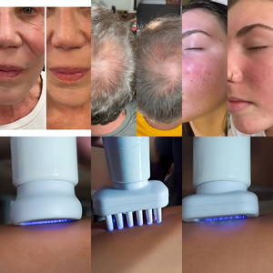 Stylo à <span class=keywords><strong>jet</strong></span> ultra-froid sans temps d'inactivité 20000V avec embouts pour le visage et les cheveux - Product Image 2
