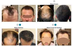 KN-8000A Kernel CE dibersihkan terapi <span class=keywords><strong>Level</strong></span> rendah 650nm mesin <span class=keywords><strong>Laser</strong></span> penumbuh rambut <span class=keywords><strong>Laser</strong></span> dingin cahaya penumbuh rambut - Product Image 4