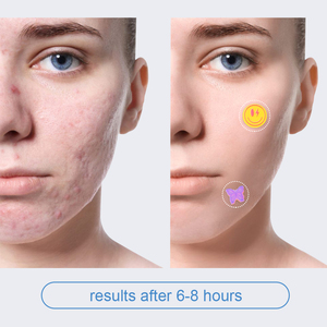 <strong>Medical</strong> Grade Hydrocolloid Pimple <strong>Patch</strong> Acne Stickers Skin Care Products - Product Image 4