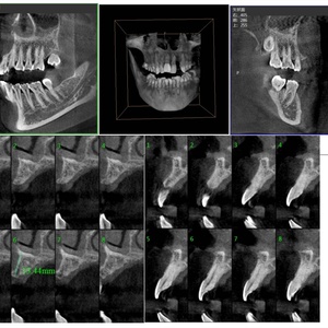 CBCT avec système d'imagerie 3D, tomodensitométrie dentaire à faisceau conique, appareil de radiographie dentaire numérique céphalométrique CBCT3000A - Product Image 2