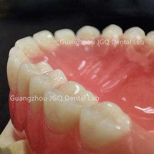 ฟันปลอมอะคริลิกคุณภาพสูงแบบสั่งทำพิเศษ ช่วยฟื้นฟูการทำงานและรูปลักษณ์ของฟันให้กลับมาเป็นธรรมชาติ - Product Image 6