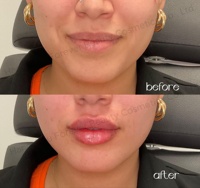 Gloss repulpant pour les lèvres à l'acide hyaluronique avec logo personnalisé, effet lissant et volume visible
