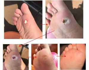 Corn Removal Pads Household Transdermal Skin Color Foot Pain Relieving Foot Corn Remover <strong>Plaster</strong> - Product Image 6