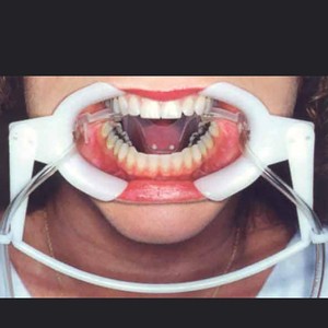 Abridor Bucal Dental con Tubo de Succión, Dispositivo Ortodóntico Ajustable para Procedimientos Dentales - Product Image 1