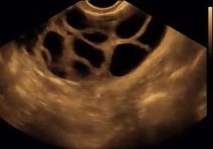 Transvaginal <span class=keywords><strong>Probe</strong></span> Ultrasound nirkabel tunggal, untuk GY OB - Product Image 6