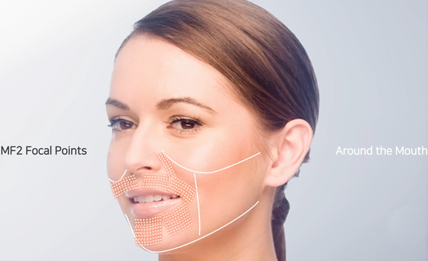 新设计 hifu vmax 皱纹减少面部提升抗衰老美容机