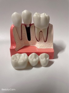 Modèle de dents dentaires modèle de Solution d'<span class=keywords><strong>implant</strong></span> 4 fois restauration de prothèse <span class=keywords><strong>dentaire</strong></span> explication d'<span class=keywords><strong>implant</strong></span> <span class=keywords><strong>dentaire</strong></span> <span class=keywords><strong>couronne</strong></span> de pont détachable - Product Image 3