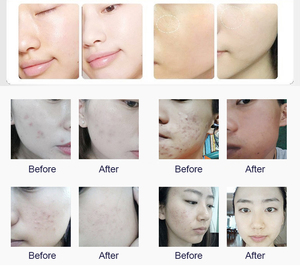 6-in-1 360 Visual Hydrogen Oxygen Hydra Dermabrasion Facial <b>Machine</b> Blackhead Remover Lifting Hydration Beauty <b>Machine</b> - Product Image 6