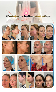 <span class=keywords><strong>Precio</strong></span> al por Mayor de Fibra Endo para Levantamiento Facial, Disolución de Grasa, Liposucción con Fibra, Reafirmación de la Piel, Endotight, Fibra de 300 micras - Product Image 6