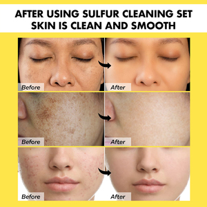 Soufre produits de soin de la peau marque privée Anti acné inflammation soufre nettoyant pour <span class=keywords><strong>le</strong></span> visage <span class=keywords><strong>savon</strong></span> nettoyant pour <span class=keywords><strong>le</strong></span> corps ensemble de soins de la peau - Product Image 5