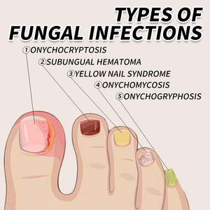 Traitement antifongique des ongles, réparation de l'onychomycose, traitement des infections fongiques des ongles endommagés - Product Image 3