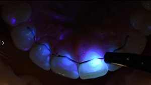 Linterna Intraoral Dental Eléctrica Inteligente con LED Inteligente para Procedimientos Dentales, Certificación CE - Product Image 3