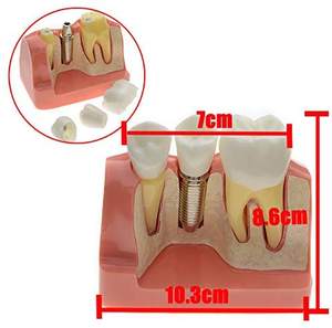 Gelsonlab HSDT-M3 4 Volte <span class=keywords><strong>Implant</strong></span> Denti Modello Dentale Modello di Impianto Analisi <span class=keywords><strong>Crown</strong></span> Ponte Dimostrazione Denti Modello per la Formazione - Product Image 5