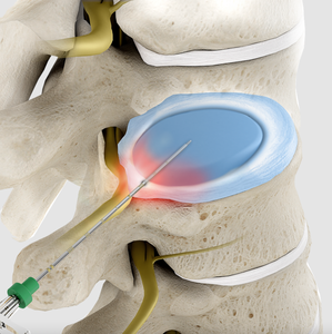 Mesin Perawatan Laser Dioda 980nm 1470nm untuk Penghapusan Varises Medis, Varises Endovenous, Varises Kapiler, dan Varises Laba-laba - Product Image 4