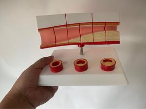 एनाटोमिकल चिकित्सा विज्ञान मानव संवहनी घावों प्रदर्शन मॉडल संवहनी ओक्शन मॉडल - Product Image 5