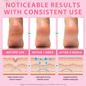 Bálsamo en Barra para Pies con Urea Ikzee de Absorción Rápida, Hidratación Profunda, Suaviza la Piel Áspera, 40g, Anti-Grietas para Talones Agrietados - Product Image 6