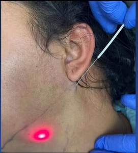 Fettverbrennung Endo-<span class=keywords><strong>Laser</strong></span> 1470nm Liposuktion Body Tite 980nm Optische Faser Endo-Haut Fettauflösung Diodenlaser-Therapie Lipo - Product Image 6