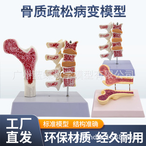 Modèle anatomique d'ostéoporose fémorale humaine, surface anatomique de l'os de la jambe, spécimen de section vertébrale, vertèbre lombaire malade - Product Image 4